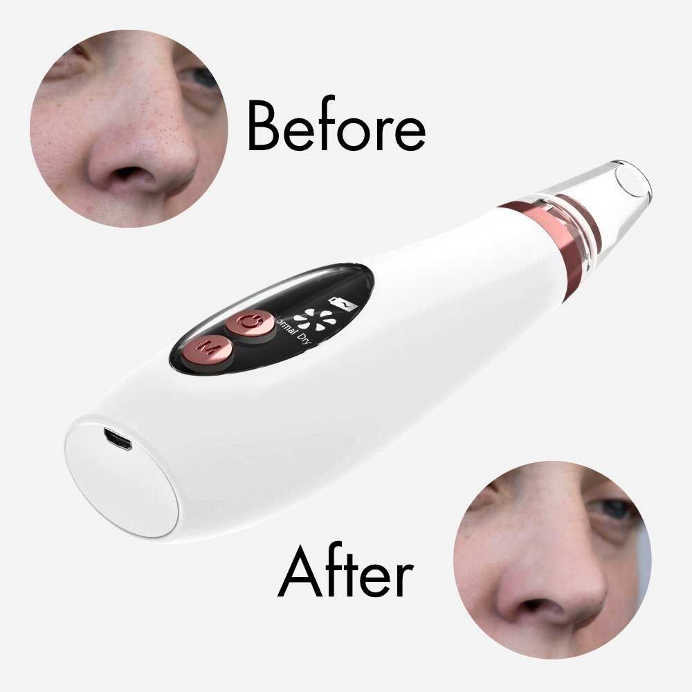Microcrystalline blackheads remover