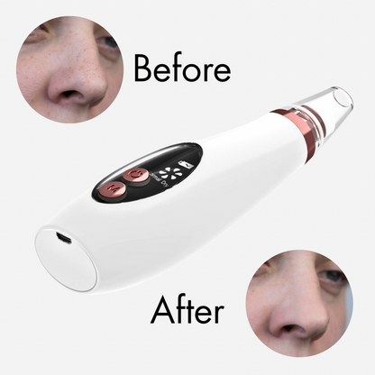 Microcrystalline blackheads remover